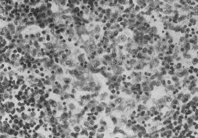 Брюшнотифозные гранулемы