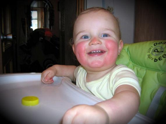 Аллергия у ребенка