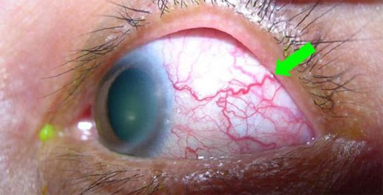 паразит в глазу