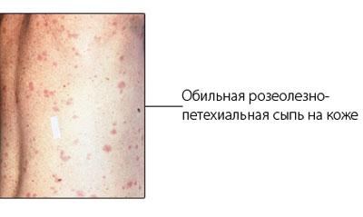 Сыпь при тифе