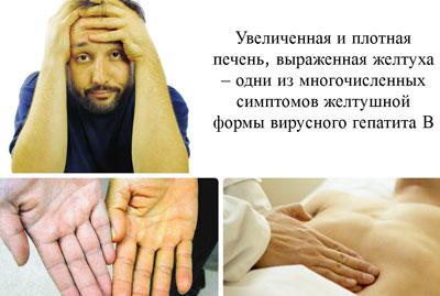 Симптомы гепатита