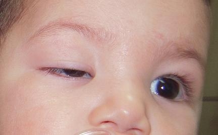 врожденный птоз у детей