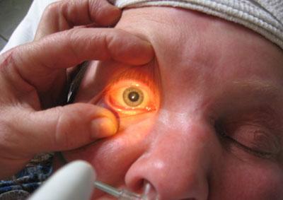 Отсутствие реакции на свет