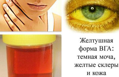 Проявление болезни Боткина