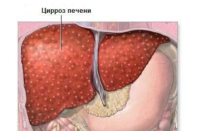 Цирроз печени