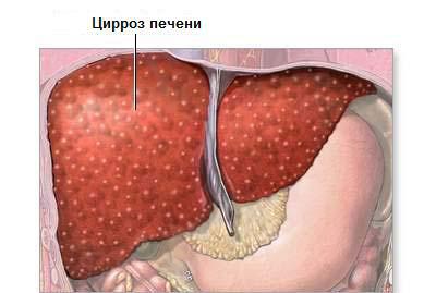 Цирроз печени