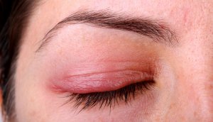 диагностика покраснений