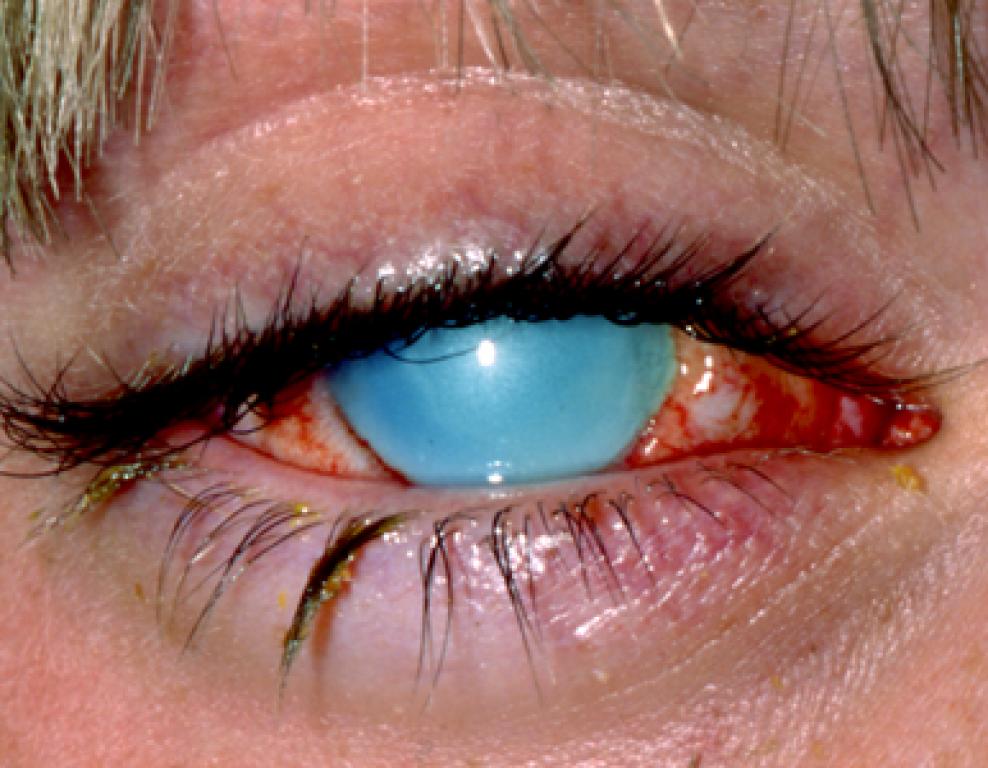 причина ожога