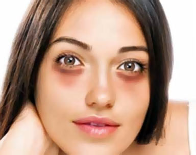 симптомы синяков под глазами