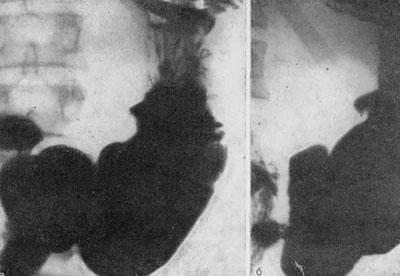 Рентген желудка