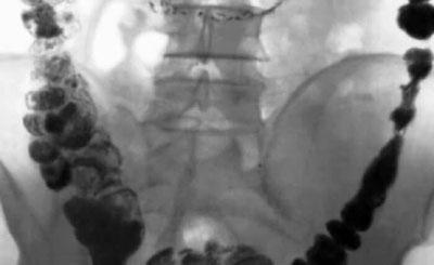 Каловые камни