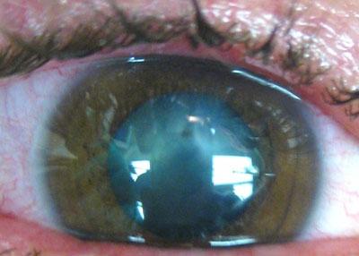 Глаз при отравлении мышьяком