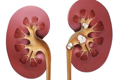 Камни в почках