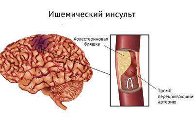 Ишемический инсульт