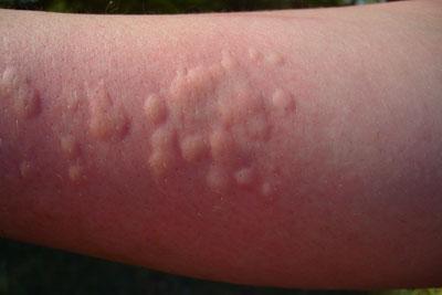 Аллергическая крапивница