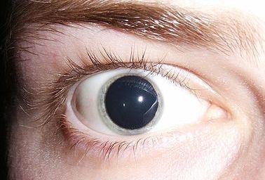 Расширенный зрачок