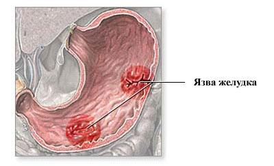 Язва желудка