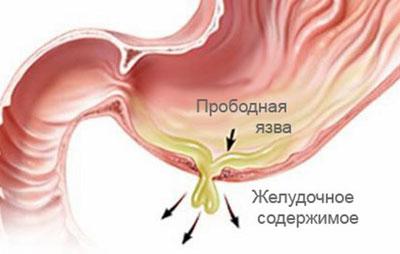 Прободная язва
