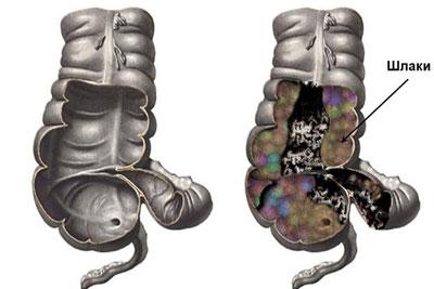 Шлаки в кишечнике