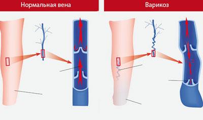 Проявление варикоза