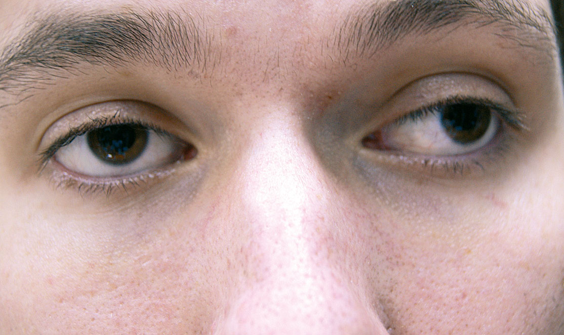 астигматизм