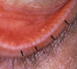 как выглядит демодекоз