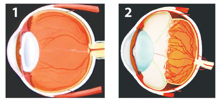 как выглядит отслоение