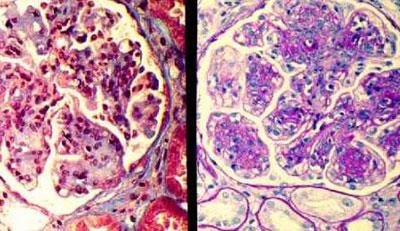 Поченая недостаточность под микроскопом