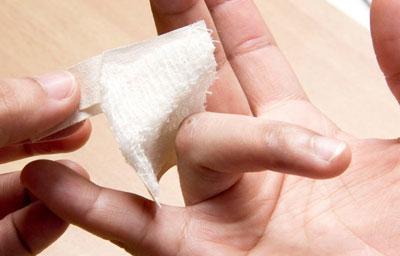 Обработка бородавки на руке