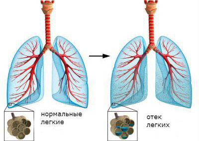 Отек легких