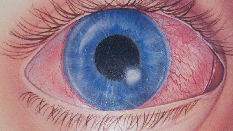 причины кератита