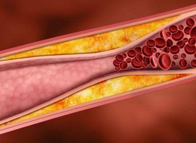 Спазм коронарного сосуда