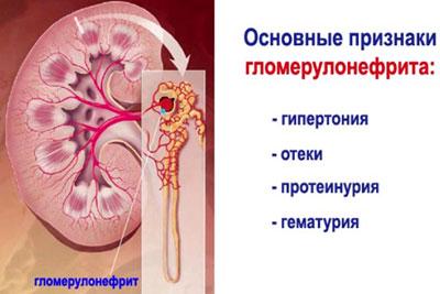 Признаки гломерулонефрита