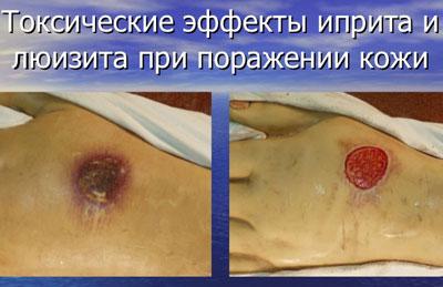 Язвы при химотравлении