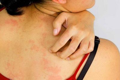 Аллергия на коже