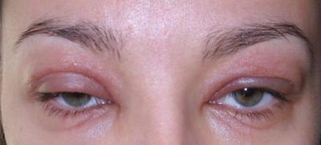 аллергия на веках