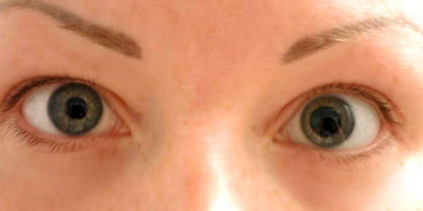 симптомы анизокория