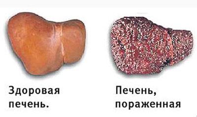 Разрушение печени