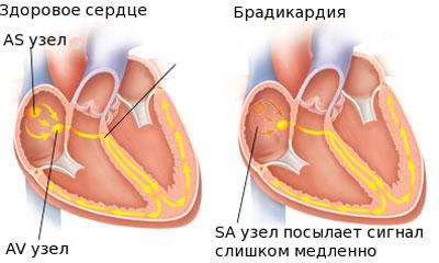 Сердце при брадикардии