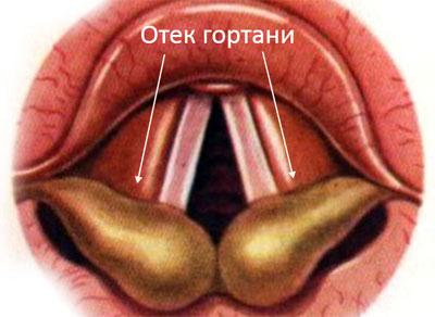 Отек гортани