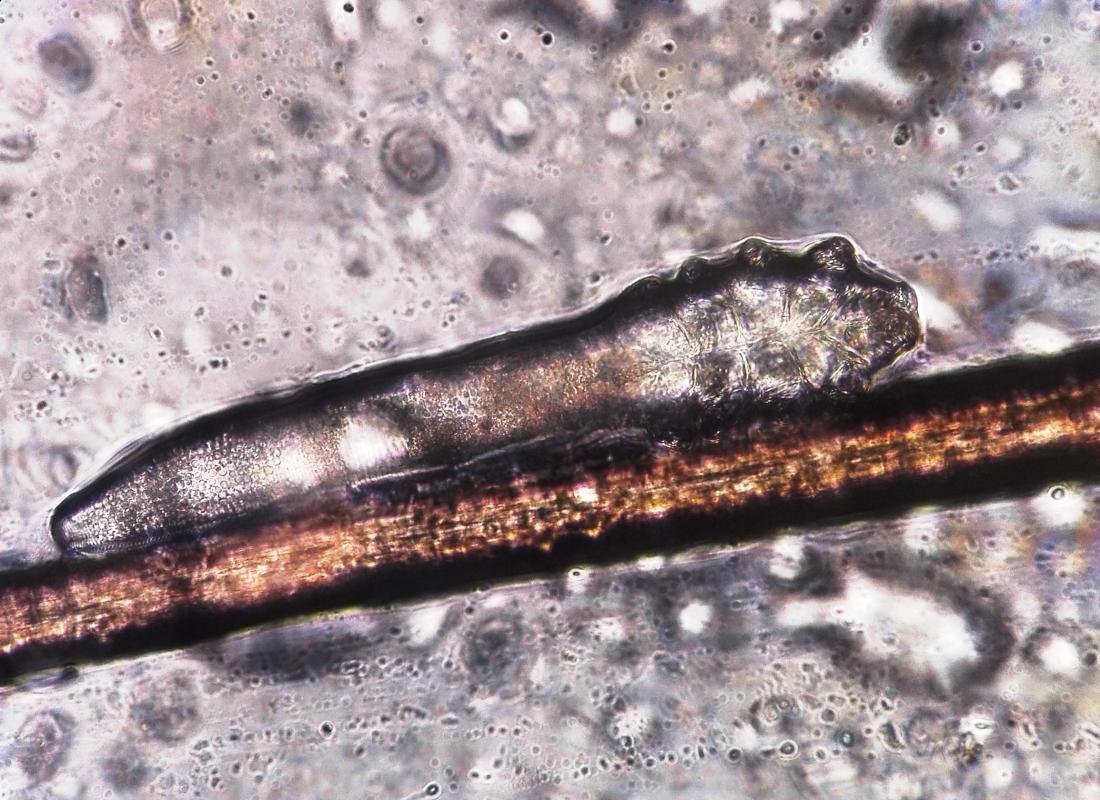 Demodex-Folliculorum2.jpg