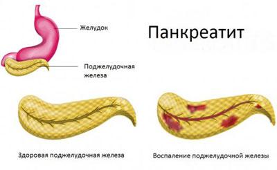 Проявление панкреатита