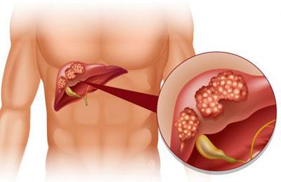Развитие цирроза печени