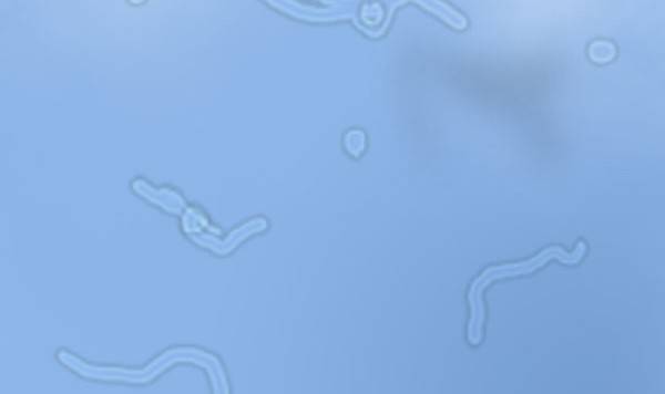 заболевание стекловидного тела