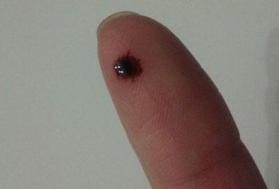 Удаление бородавки чистотелом