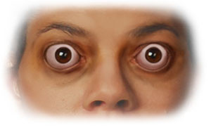 причины эндокринной офтальмопатии