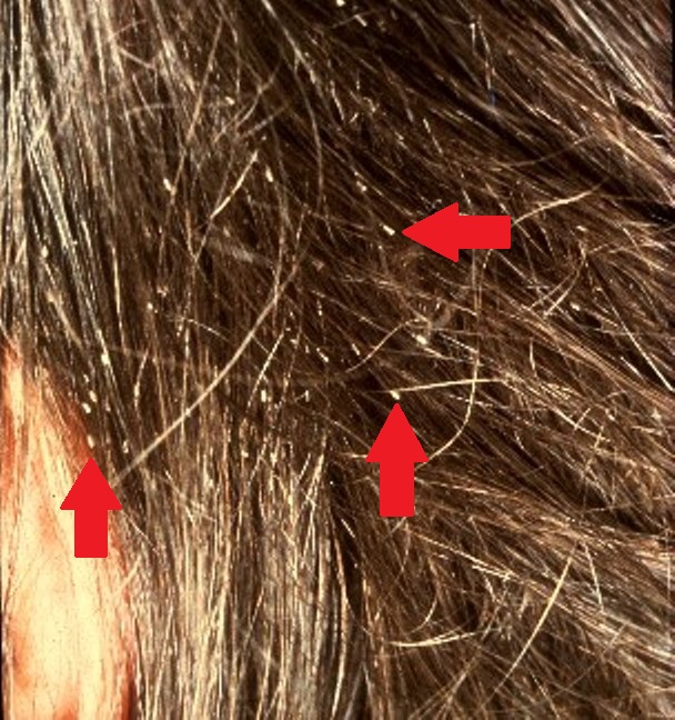 Fig._5._Louse_nits1.jpg