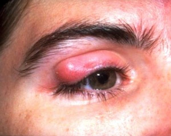 гной из глаз