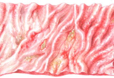 Некроз желудочной ткани