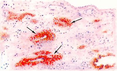 Кровоизлияния в мозге